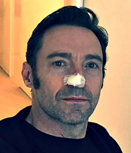 Hugh Jackman operato al naso Hugh Jackman operato al naso